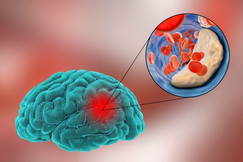 Cerebro que ha sufrido un Accidente Cerebrovascular (ACV)