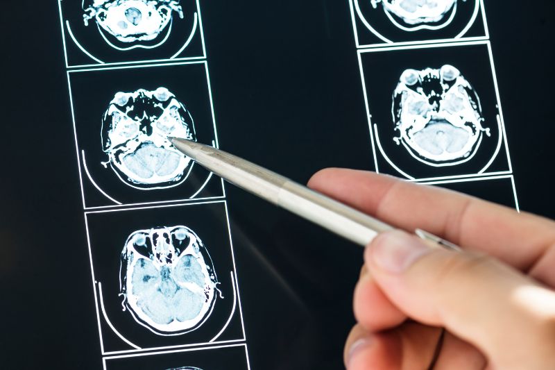 Ataxia cerebelosa radiografía